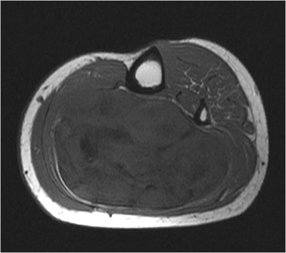 Low Grade Fibromyxoid Sarcoma 3831